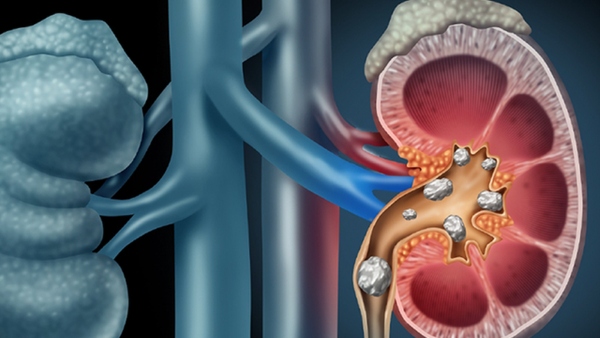 Hỗ trợ ngăn ngừa sỏi thận