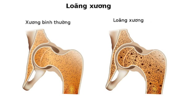 Ngăn ngừa và điều trị loãng xương