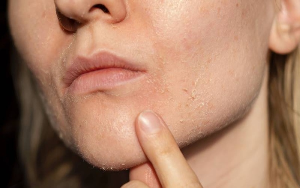 Tình trạng mất nước và khô da